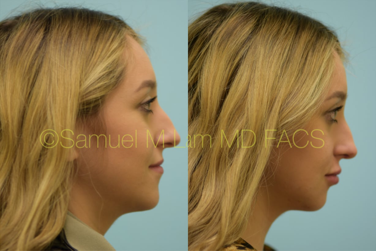 jaw reduction