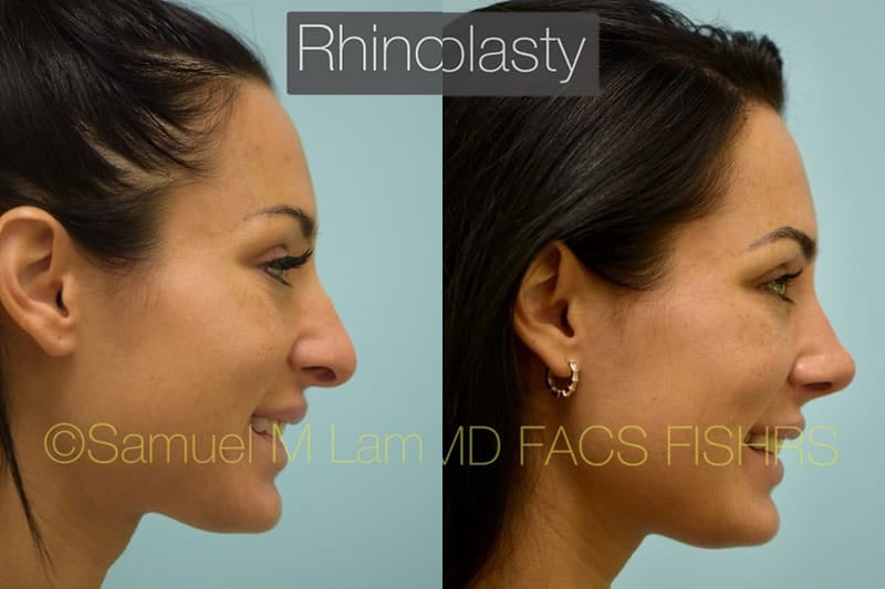 asian nose job