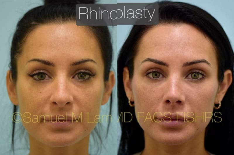 jaw reduction
