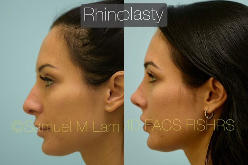 jaw reduction