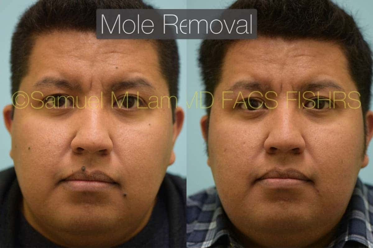 Skin Lesions / Mole Removal Photos
