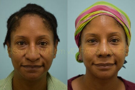 Nasal Tip Rhinoplasty Result Dallas