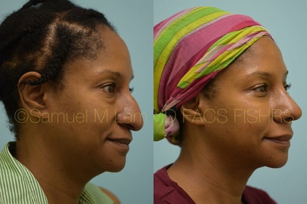 Aging Nose Rhinoplasty Photos