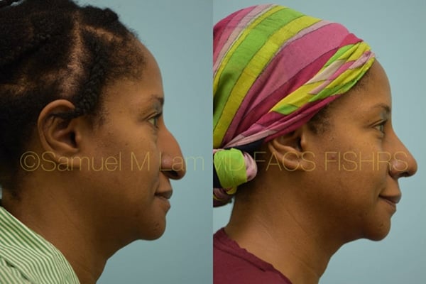 Aging Nose Rhinoplasty Photos
