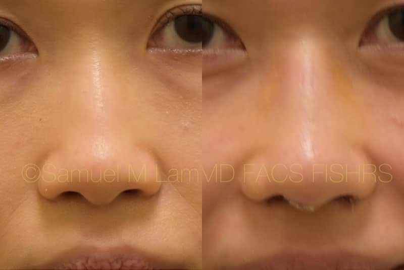 asian nose job