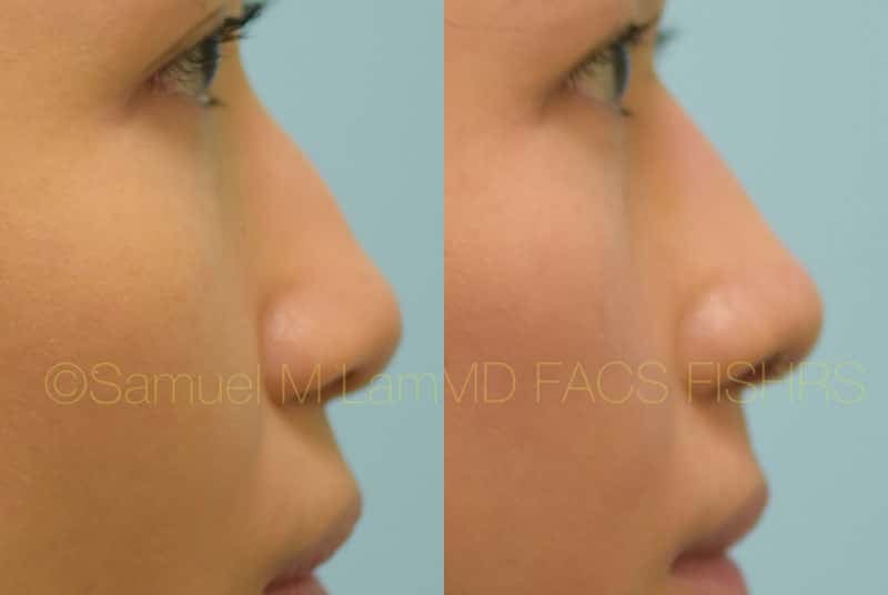 asian nose job