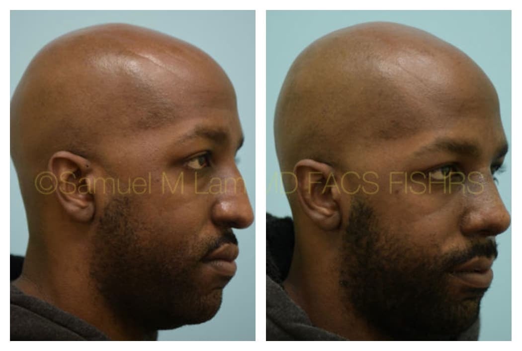 Aging Nose Rhinoplasty Photos