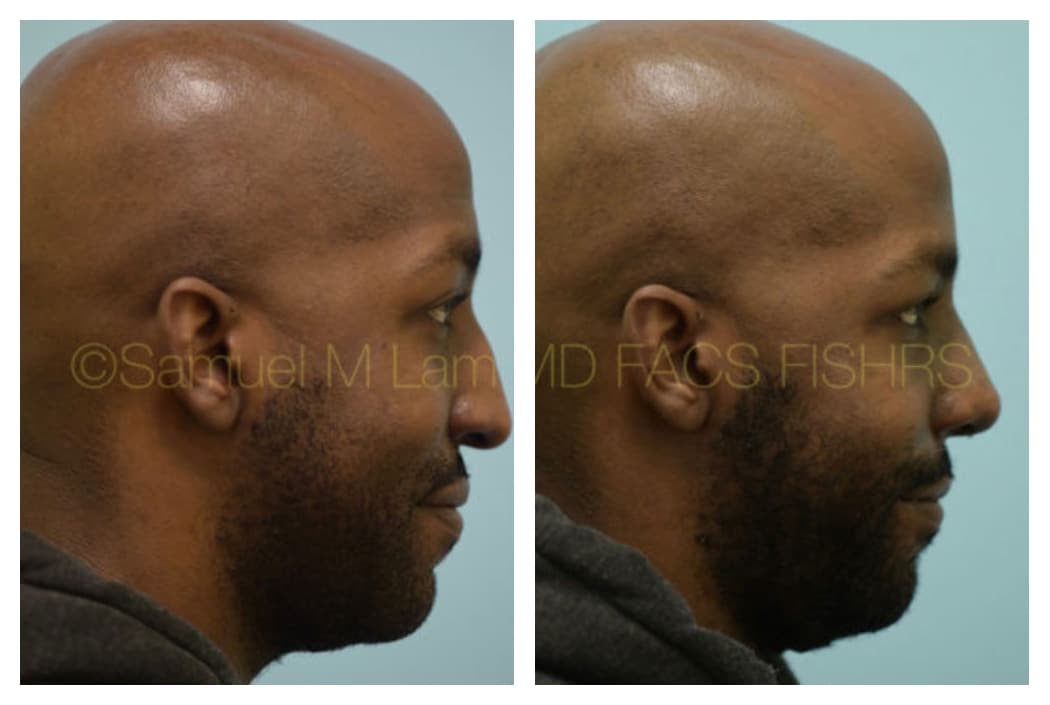 Aging Nose Rhinoplasty Photos