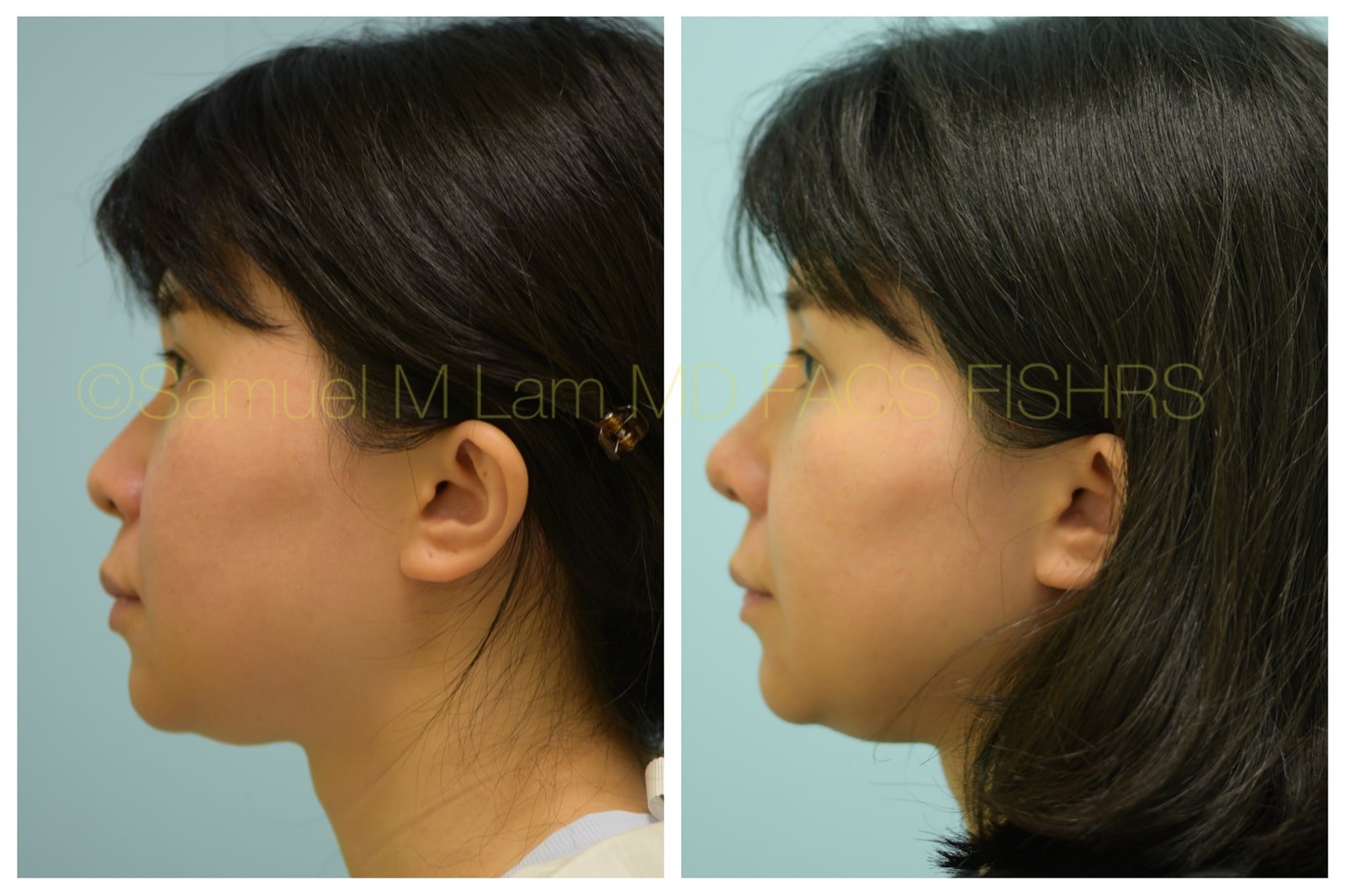 jaw reduction