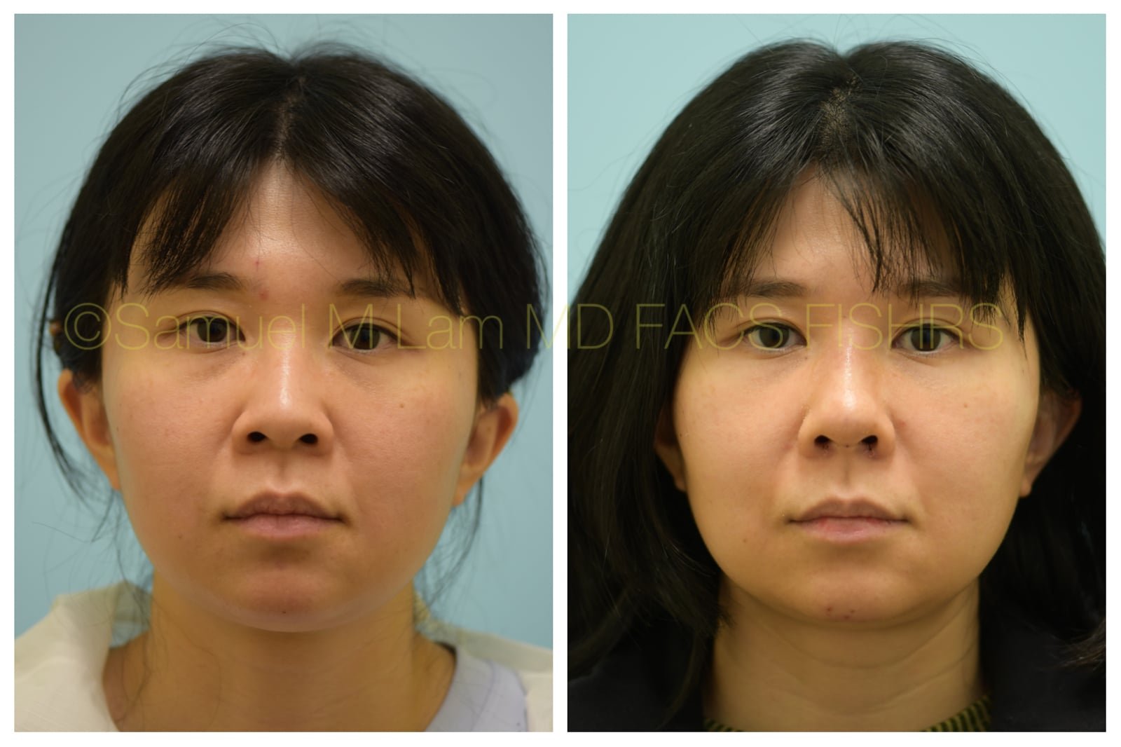 lip reduction