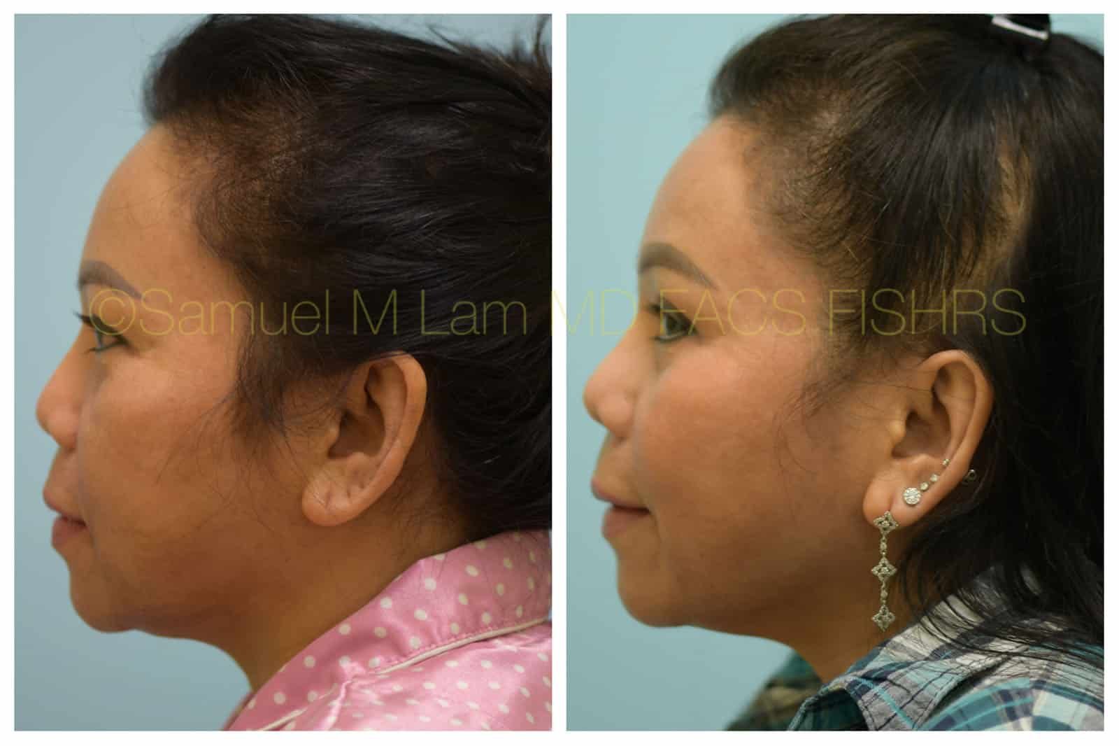 asian nose job