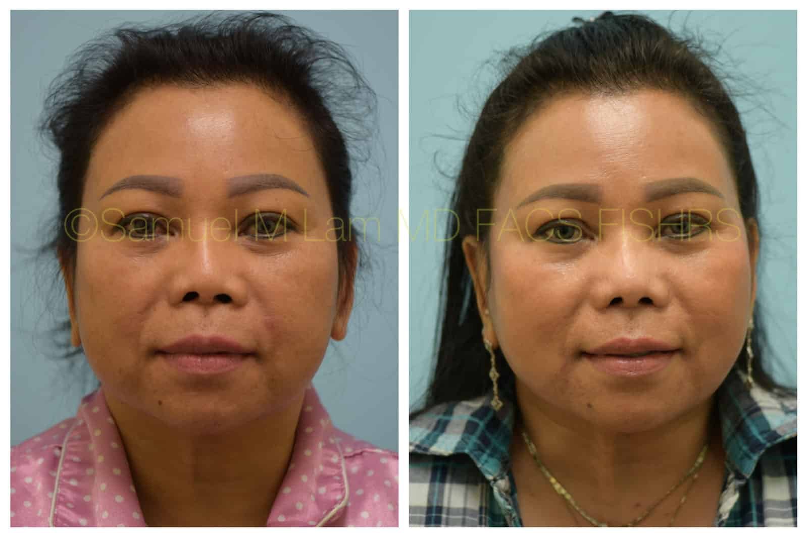 asian nose job
