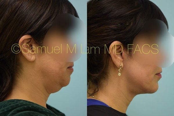 Neck Lift, Deep Neck Lift, Direct Neck Lift Results Garland