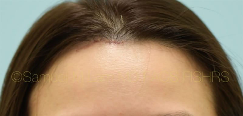 osteoma patient after osteoma patient after
