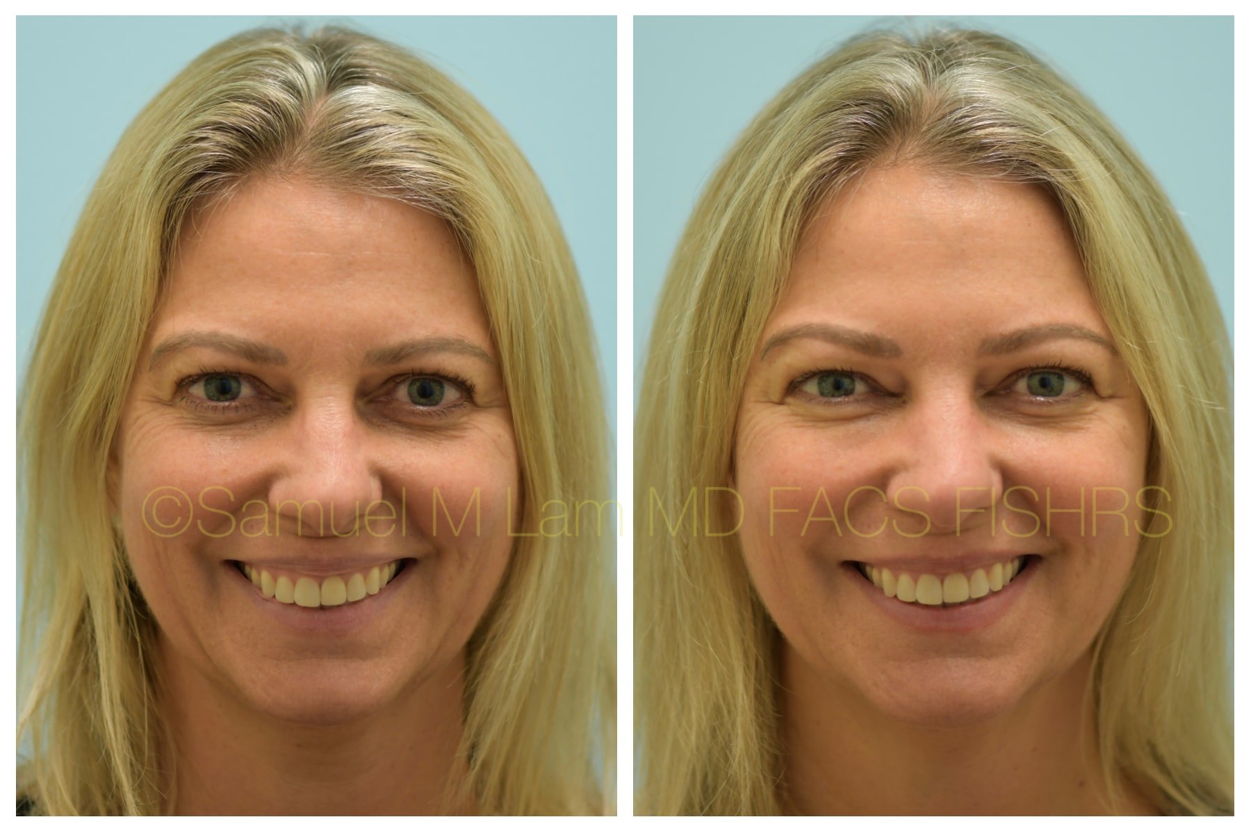 lip reduction lip reduction