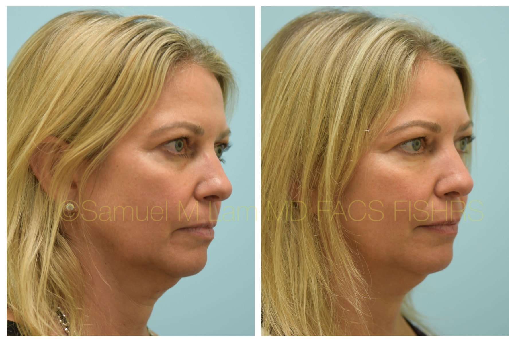 lip reduction lip reduction