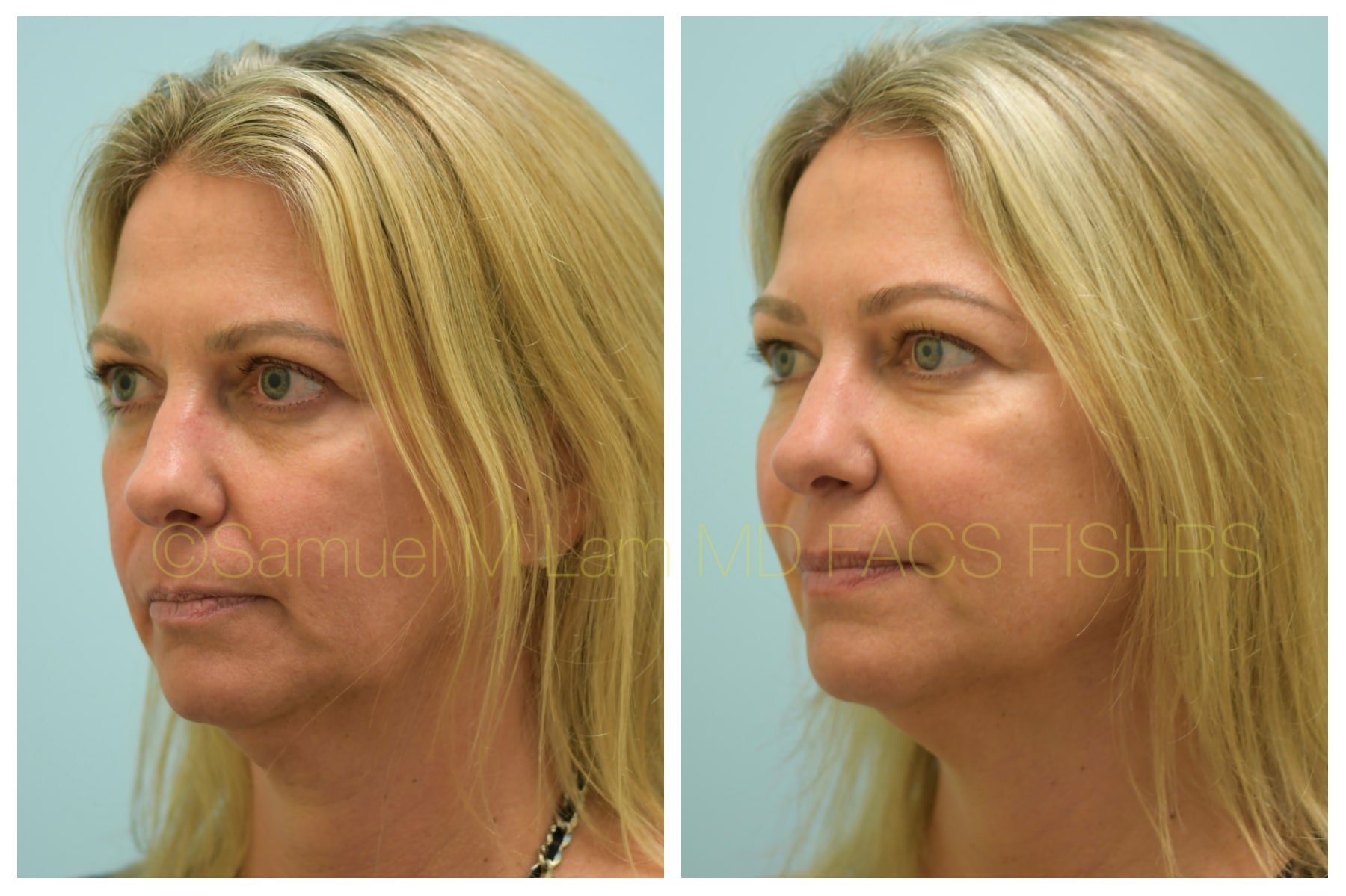 jaw reduction jaw reduction