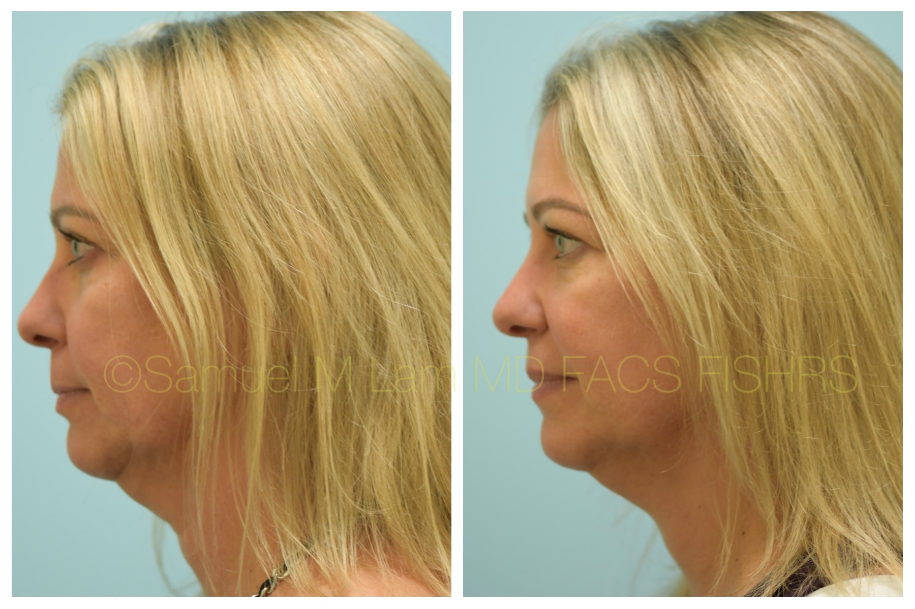 lip reduction lip reduction