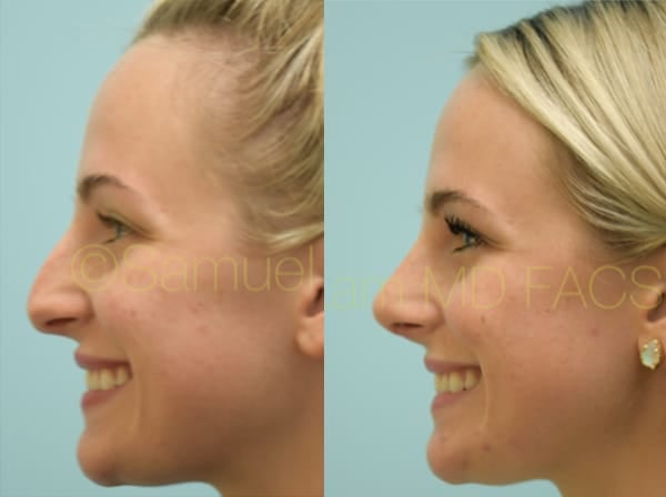 asian nose job