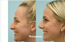 Rhinoplasty Before and After Plano, TX