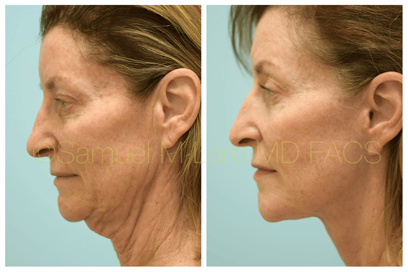 facelift-4