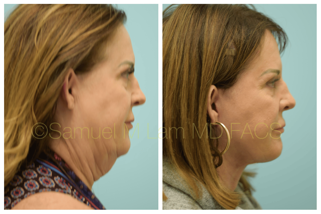 facelift-3