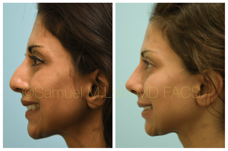 lip reduction