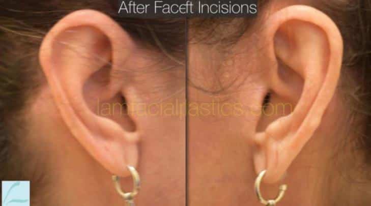 After Facelift Incision