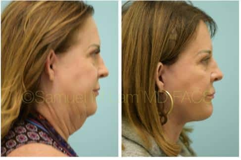 Before and After Facelift