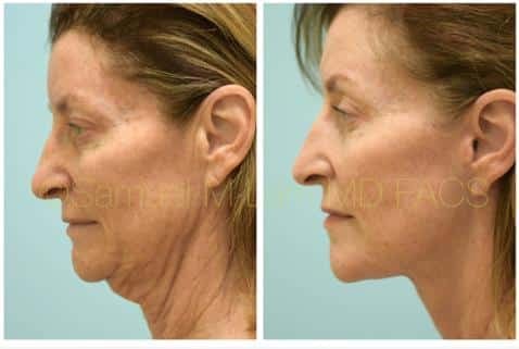Facelift Procedure Before and After Photos