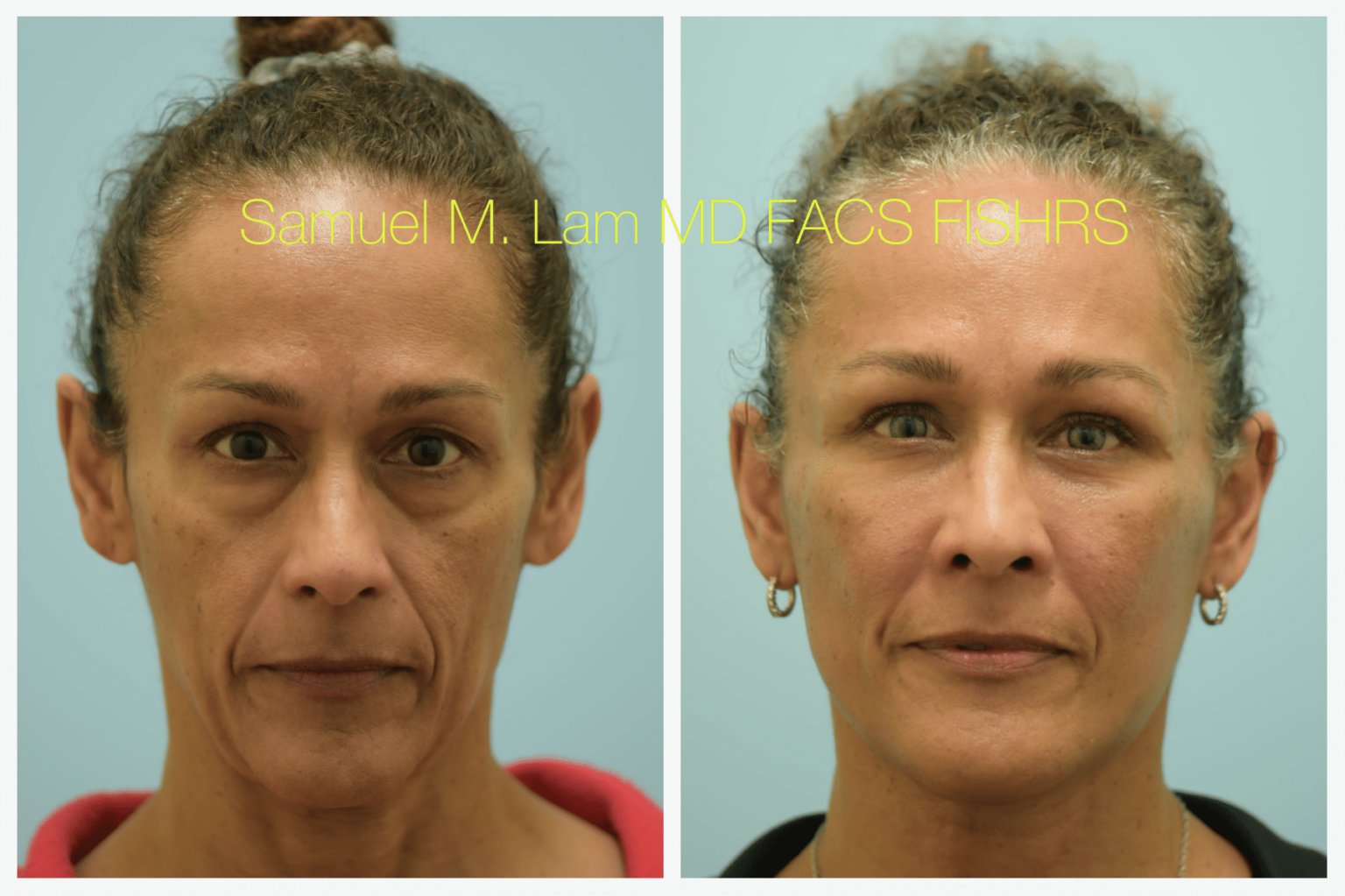 blepharoplasty before and after 1 of 4
