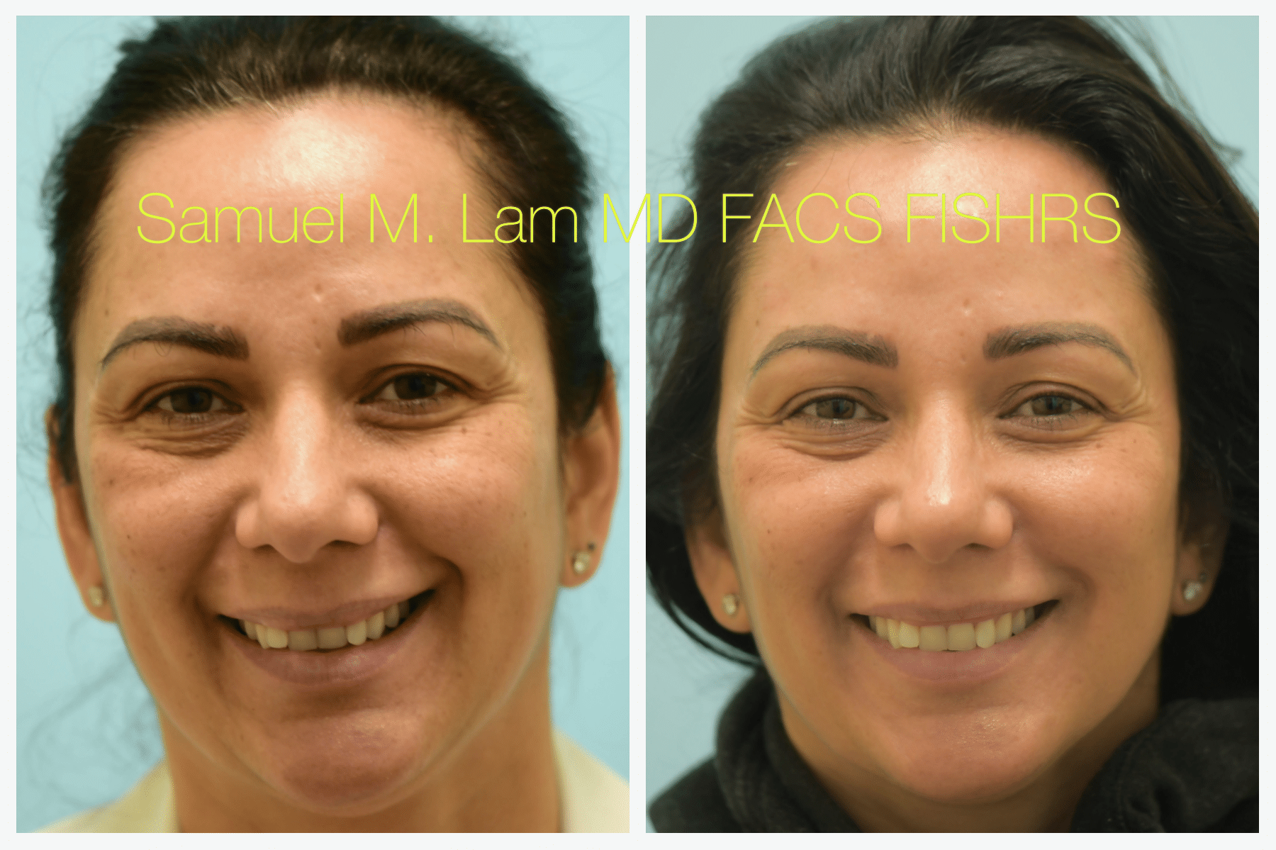 IMG W dr lam dermal fillers IMG W dr lam dermal fillers