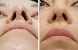 Rhinoplasty Before and After Plano, TX