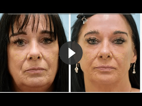 video mesotox testi