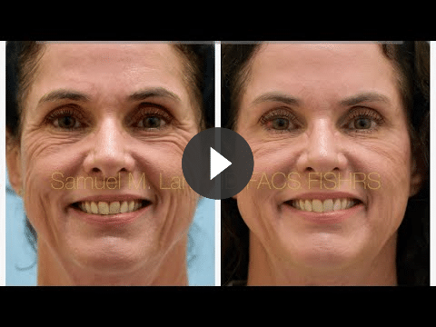 video mesotox testi