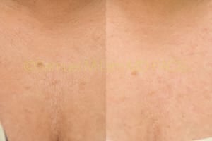 MesoTox Results Dallas