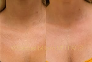 MesoTox Results Dallas