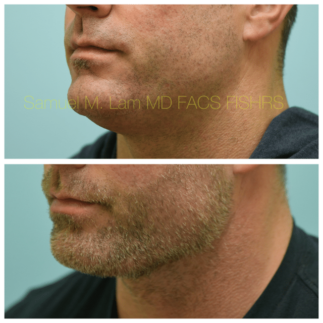 Facelift Before and After Photo by Dr. Lam in Plano TX