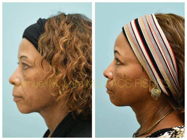 Blepharoplasty fat grafting fillers MesoBotox lip lift Before and After Photo by Dr. Lam in Plano TX