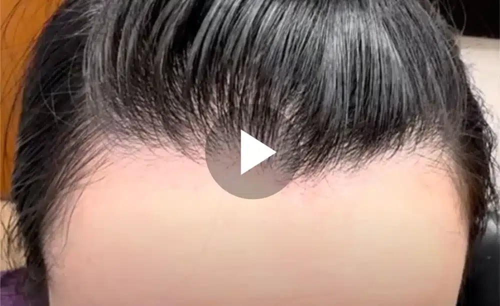 Year Out Osteoma Incision Close Up video thumb