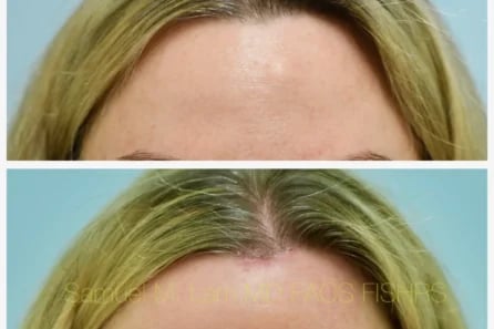 Before After Photos Osteoma Removall Before After Photos Osteoma Removall