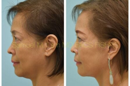 Facelift Before and After Photo by Dr. Lam in Plano TX of