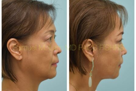 Facelift Before and After Photo by Dr. Lam in Plano TX of