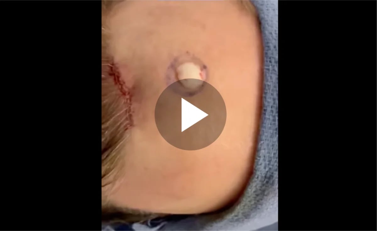 Osteoma Removal Right Afterward