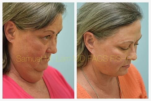 facelift before after dallas