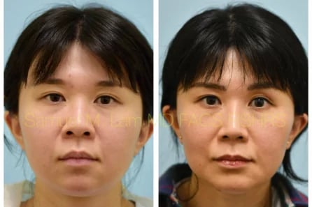 Front Rhinoplasty, Chin Augmentation, Facelift Before and After Photo by Dr. Lam Front Rhinoplasty, Chin Augmentation, Facelift Before and After Photo by Dr. Lam