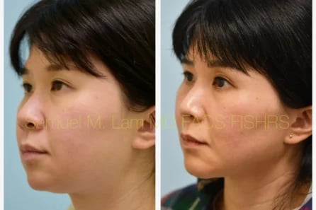 Left Oblique Rhinoplasty, Chin Augmentation, Facelift Before and After Photo by Dr. Lam Left Oblique Rhinoplasty, Chin Augmentation, Facelift Before and After Photo by Dr. Lam