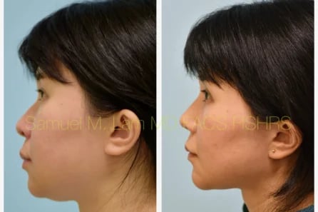 Left Profile Rhinoplasty, Chin Augmentation, Facelift Before and After Photo by Dr. Lam Left Profile Rhinoplasty, Chin Augmentation, Facelift Before and After Photo by Dr. Lam