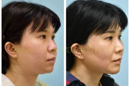 Right Oblique Rhinoplasty, Chin Augmentation, Facelift Before and After Photo by Dr. Lam Right Oblique Rhinoplasty, Chin Augmentation, Facelift Before and After Photo by Dr. Lam