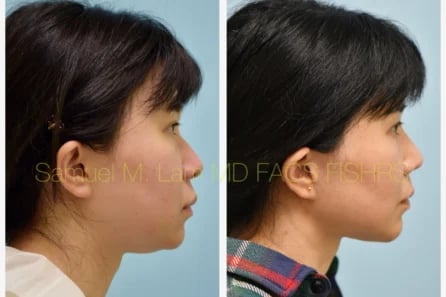 facelift-1